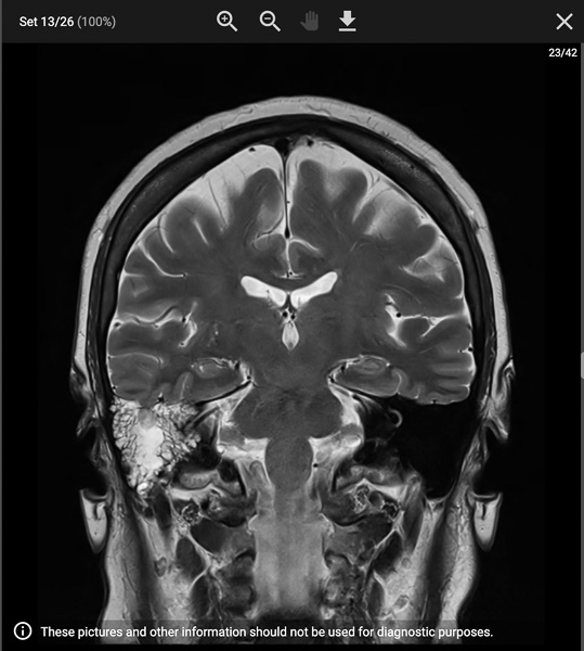 IIH broken though the bone that separates my skull from my ear canal. 
